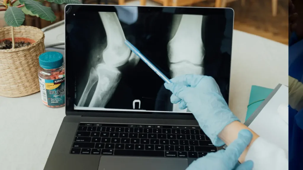 ACL Injury Treatment Options 2 xray